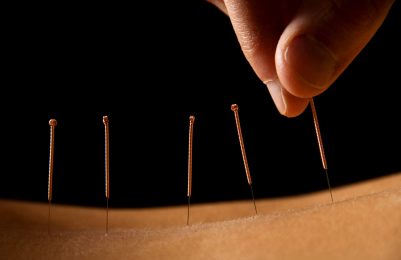 Dry Needling